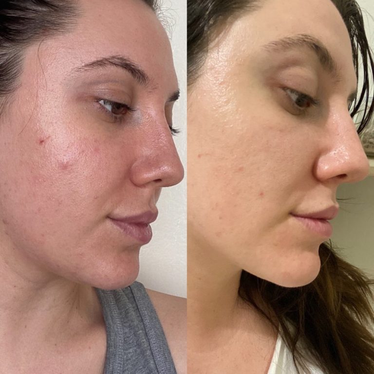 TRUE TRANSFORMATION “I wanted to feel confident in my skin without having to hide it with makeup”